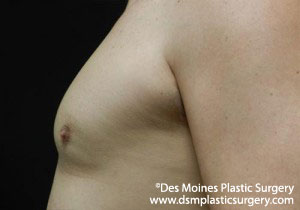 After Coolsculpting for Men - sideview