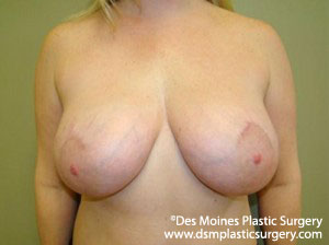 After Breast Lift and Augmentation