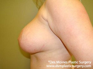 Before Breast Lift and Augmentation - sideview