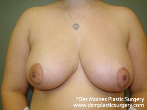 Breast Reduction Result Des Moines