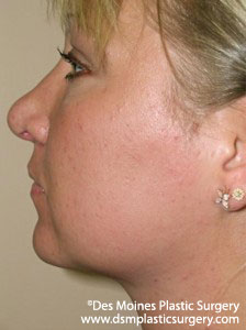 After Neck Liposuction - sideview