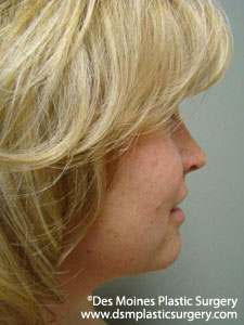 After Neck Liposuction