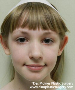 Girl Before Ear Surgery