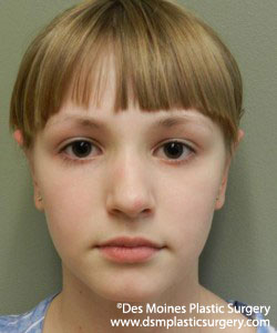 Girl undergone Ear Surgery - After