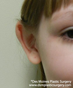 Ear Surgery - Before