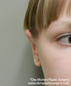 Ear Surgery - After