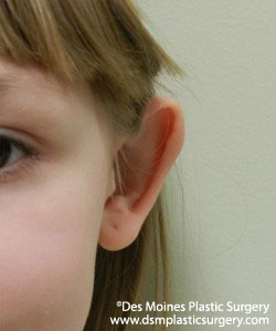 Ear Surgery - Before