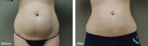 SmartLipo™ Des Moines Before and After