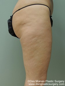 Before Thigh Lift - sideview