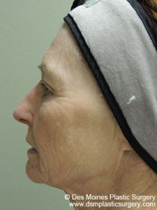 Before Facelift Procedure - Sideview