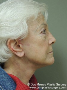 After Facelift Procedure - Sideview