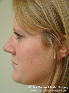After Rhinoplasty - sideview