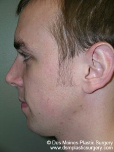 Before Chin Augmentation - sideview