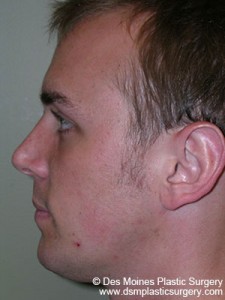 After Chin Augmentation - sideview