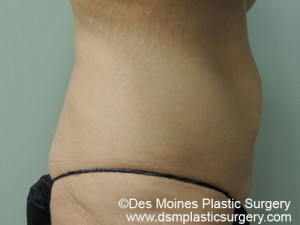 Before Tummy Tuck - sideview