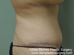 After Tummy Tuck - sideview