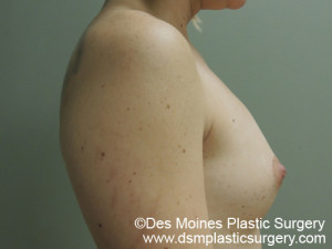 Before Breast Augmentation - sideview