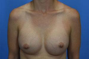 After Breast Augmentation