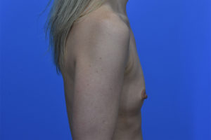 Before Breast Augmentation - right sideview