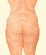 skin surgery after weight loss des moines