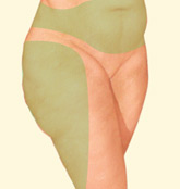 liposuction thighs abdomen