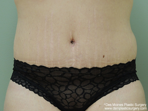 Before & After Tummy Tuck | DSM Plastic Surgery Des Moines, IA