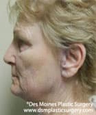 side of woman's face before surgery