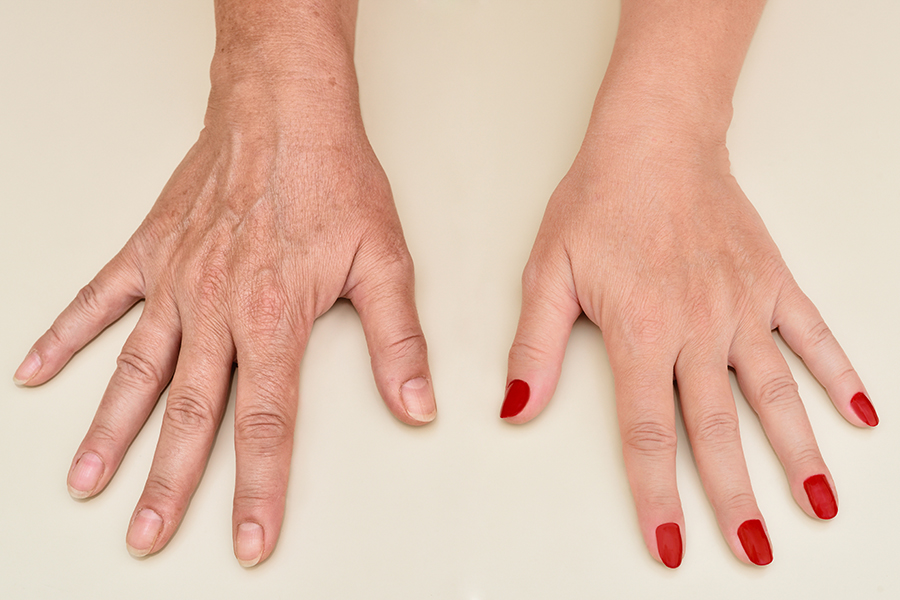 Hands Of A Woman Before And After Skin Treatment