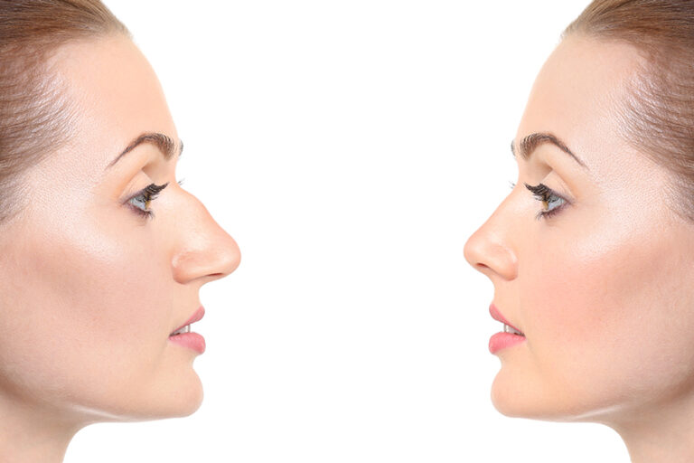 Rhinoplasty Des Moines