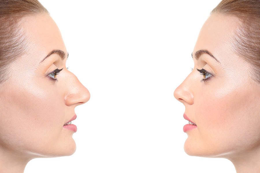 Young Woman Before And After Rhinoplasty On White Background. Pl
