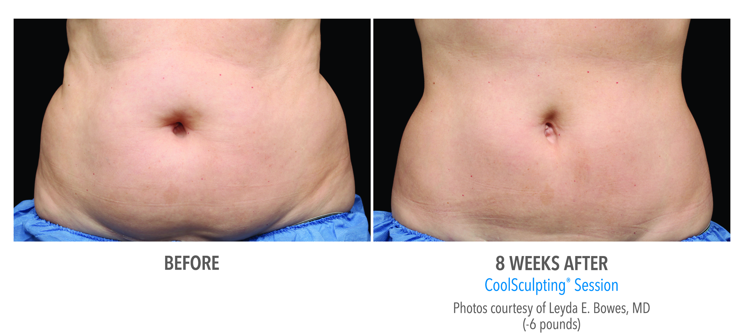 Just Freeze It! 3 Abdomen Coolsculpting Before And After Photo In West Des Moines, Ia