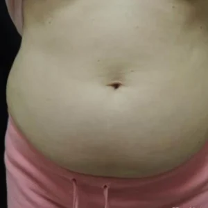 CoolSculpting before and after photos