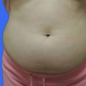 CoolSculpting before and after photos