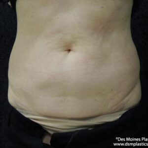 CoolSculpting before and after photos