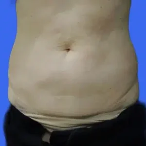 CoolSculpting before and after photos CoolSculpting before and after photos