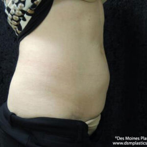 CoolSculpting before and after photos