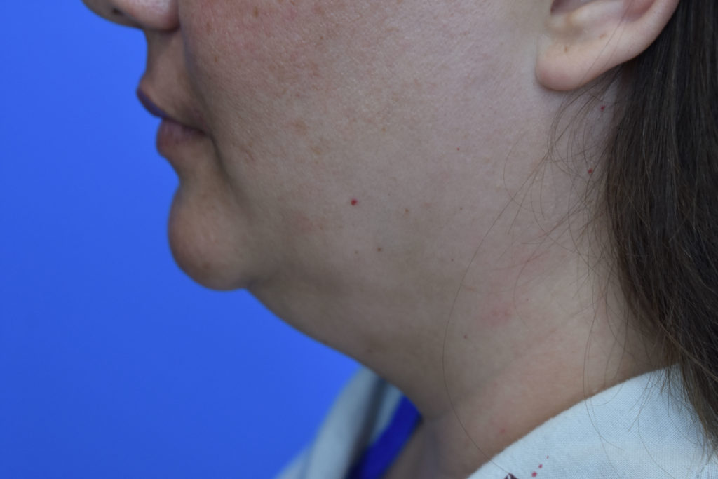 Neck Liposuction before and after photos