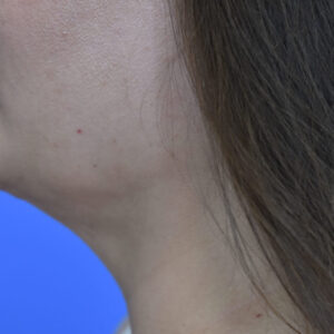 Neck Liposuction before and after photos