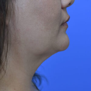 Neck Liposuction before and after photos