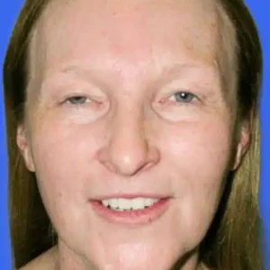 Brow Lift before and after photos