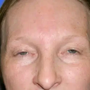 Brow Lift before and after photos