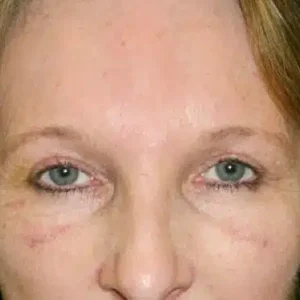 Brow Lift before and after photos