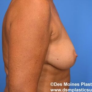 Breast Lift with Augmentation before and after photos