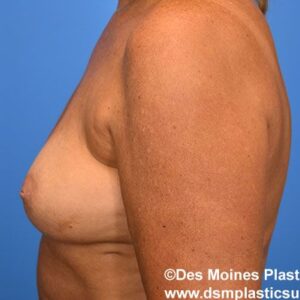 Breast Lift with Augmentation before and after photos