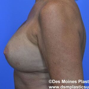 Breast Lift with Augmentation before and after photos
