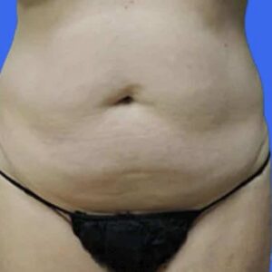SmartLipo before and after photos