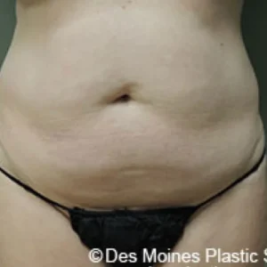 SmartLipo before and after photos