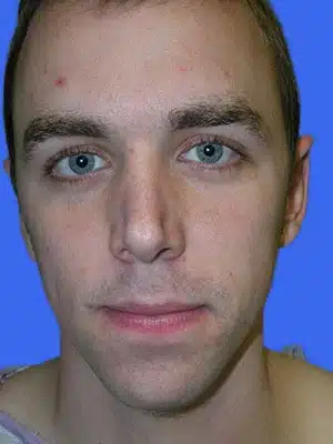 Chin Augmentation before and after photos