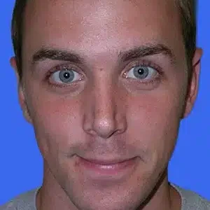 Chin Augmentation before and after photos