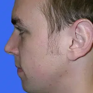 Chin Augmentation before and after photos